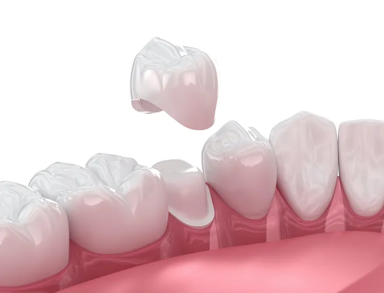 How to Care for a New Dental Crown in Metairie, LA
