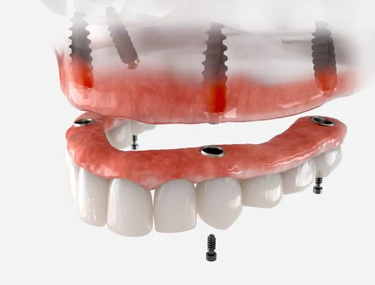 Implant Dentures: A New Smile for a Full Arch in Metairie, LA